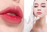 5 dáng môi tiêm filler đẹp khiến nàng “thăng hạng” nhan sắc